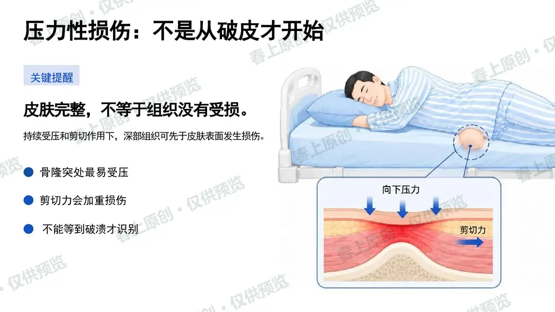 压力性损伤预防与护理管理预览第4页