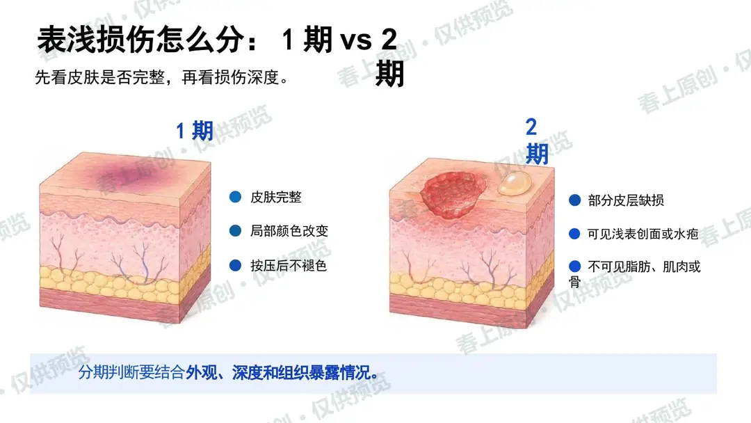 压力性损伤预防与护理管理预览第21页